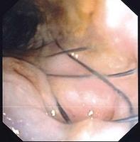 Perforation of the bronchial wall