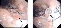 Perforation of the bronchial wall