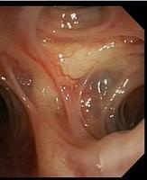 Bronchial diverticula