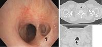 Tracheal diverticulum - annotations