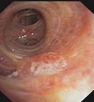 Raised mucosa