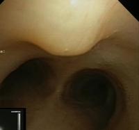Cartilagenous protuberance