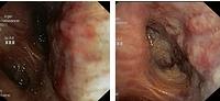 Raised, irregular, infiltrated mucosa