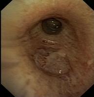 Exophytic lesion with smooth surface