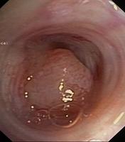 Exophytic lesion with a smooth surface