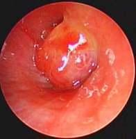 Exophytic mass with a smooth, shiny and erythematous surface