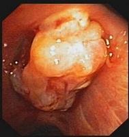 Exophytic lesions with irregular polylobulated surface