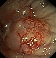 Exophytic lesions with hypervascularized surface