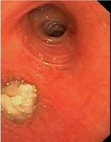 Exophytic lesions with necrotic surface