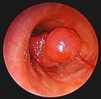 Polypoid, double cone-shaped exophytic lesion