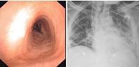 Tracheal deviation