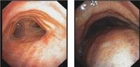 Functional stenosis or obstruction: tracheobronchomalacia and excessive dynamic airway collapse (EDAC)