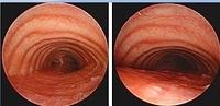 Excessive dynamic airway collapse (EDAC) associated with bronchomegaly