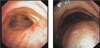 Excessive dynamic airway collapse (EDAC)