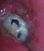Stenosis due to fibrin deposition