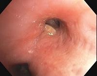 Stenosis associated with tuberculosis