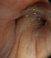 Stenosis due to extrinsic compression