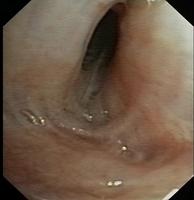 Distortion of a bronchial orifice