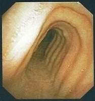 Saber-sheath (scabbard) trachea