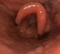 Epiglottis