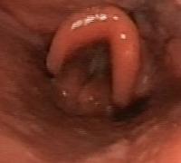 Erythematous epiglottis