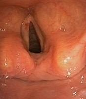 Vocal cords