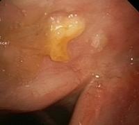Nodular lesion covered with fibrin