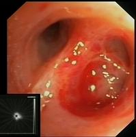 Radial ultrasound