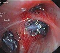 Bronchoscopic techniques