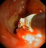 Cryobiopsy