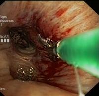 Endobronchial biopsy