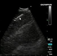 EBUS-TBNA needle