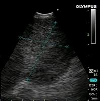 Mediastinal lymphadenopathy