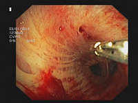 Miniforceps biopsy of mediastinal and hilar lesions