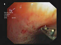 Miniforceps biopsy of mediastinal and hilar lesions