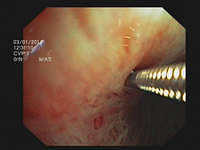 Miniforceps biopsy of mediastinal and hilar lesions