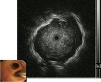 Radial endobronchial ultrasound