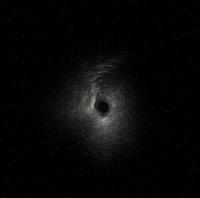 Radial ultrasound: Ground glass opacity (blizzard sign)