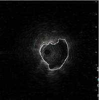 Radial US: nodule visualisation (annotated)