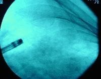 BTB: the bronchoscope is placed in the selected bronchus