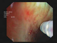 Transbronchial needle aspiration (TBNA)