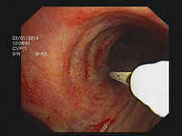 Transbronchial aspiration