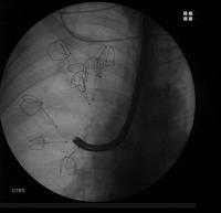 Endobronchial coils