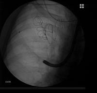 Lung volume reduction with coils: the guidewire has been removed and the catheter remains in place