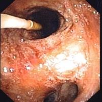 Fogarty balloon catheter before inflation