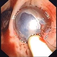 Hemostasis with Fogarty balloon catheter