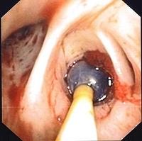 Hemostasis with Fogarty balloon catheter