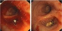 Hemostasis with Tabotan