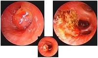 Laser coagulation