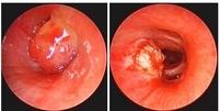 Electrocoagulation (electrosurgery, electrocautery, diathermy) - including Argon plasma coagulation